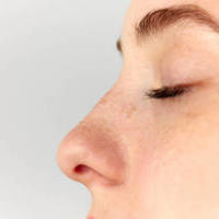 Rhinoplasty in Riyadh