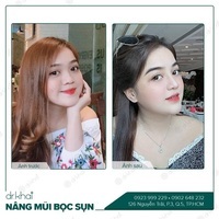 Nâng mũi Bọc sụn | Bác sĩ Khải TPHCM